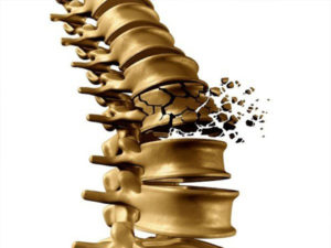 osteoporosi rimedi naturali